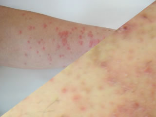 チャドクガと虫刺され